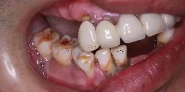 牙龈癌的早期三大症状图片